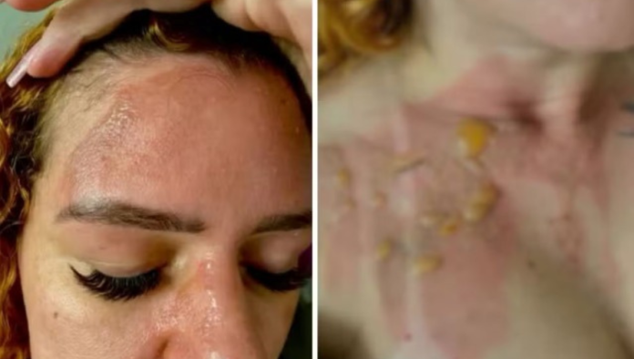 influencer-fica-com-queimaduras-no-rosto-apos-panela-de-pressao-explodir